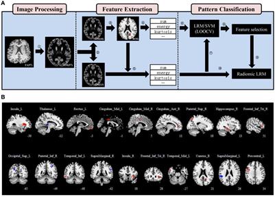 Neuroanatomical Features That Predict Response to Electroconvulsive Therapy Combined With Antipsychotics in Schizophrenia: A Magnetic Resonance Imaging Study Using Radiomics Strategy